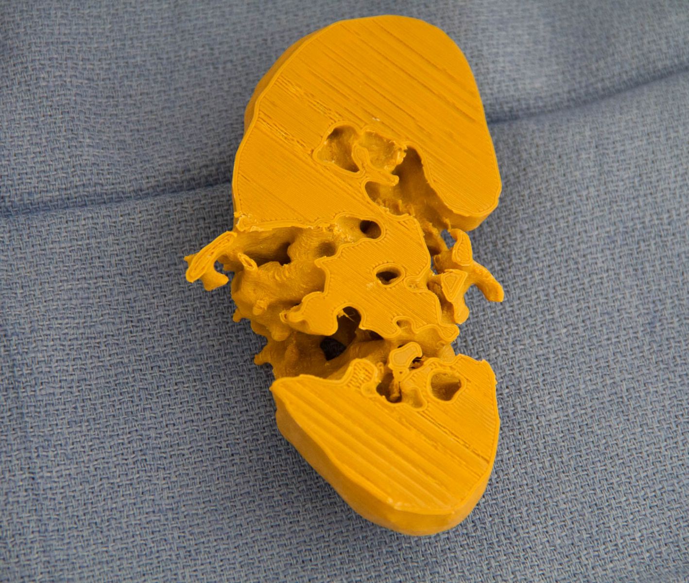 3D printed renal mass section