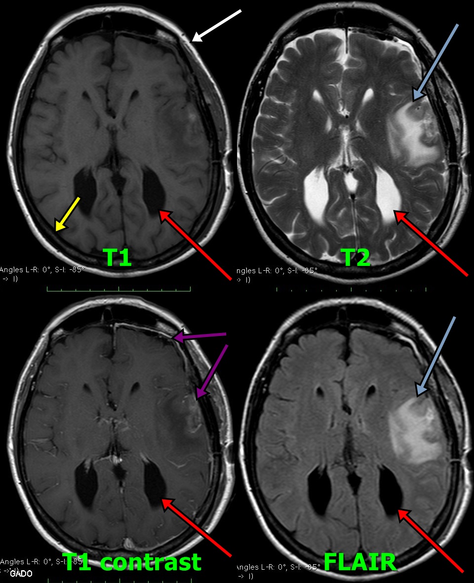 Brain MRI labelled 2