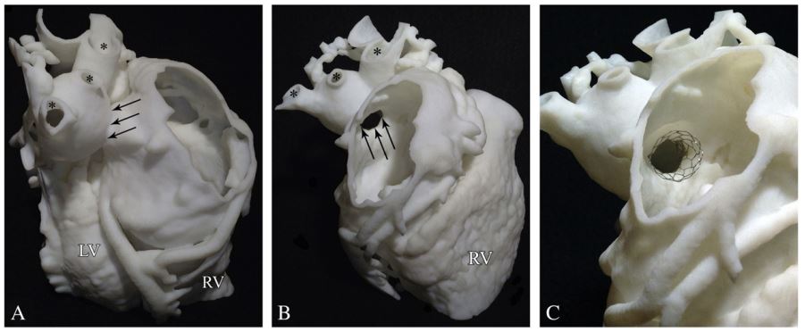 3D printed model of a congenital heart defect