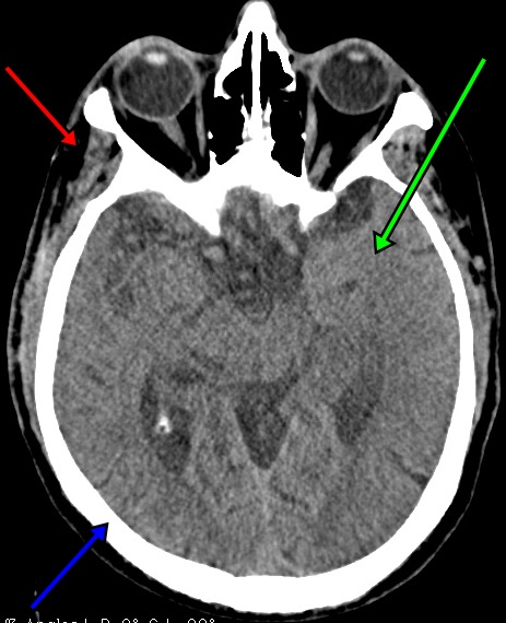 CT Brain noncon labelled