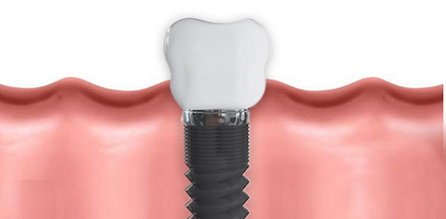 large.dental-implants.png.0c58511314aba9